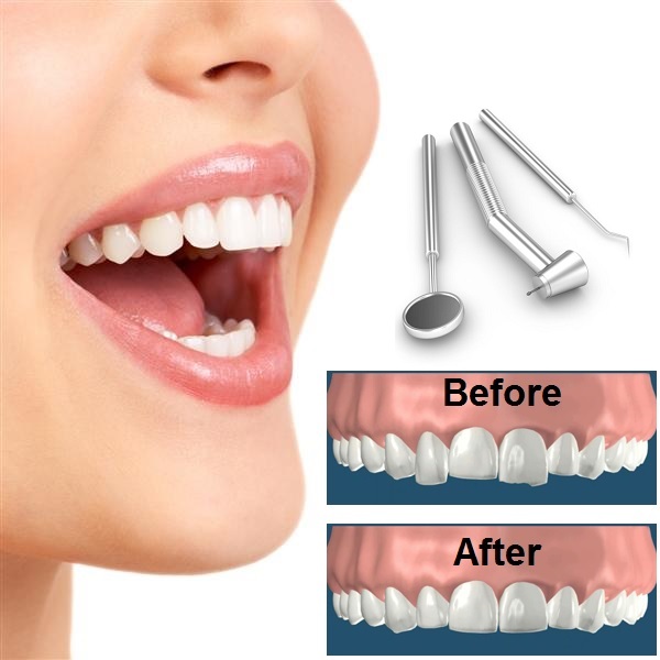 Tooth Reshaping